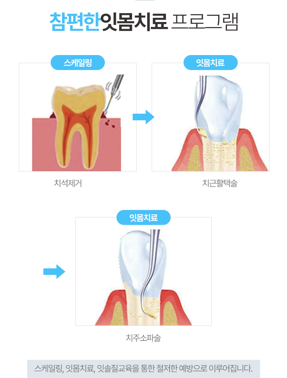 참현한 잇몸치료 프로그램